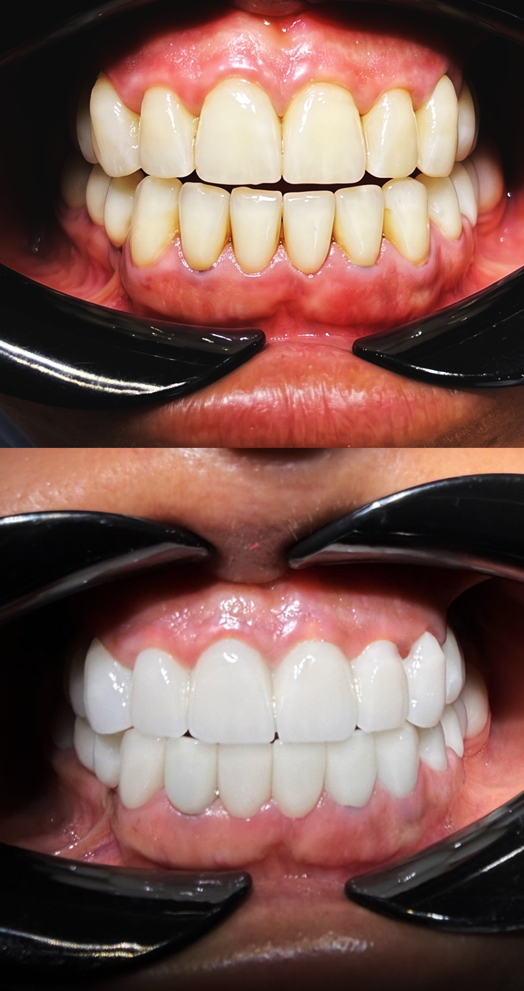 Porcelain veneers before and after