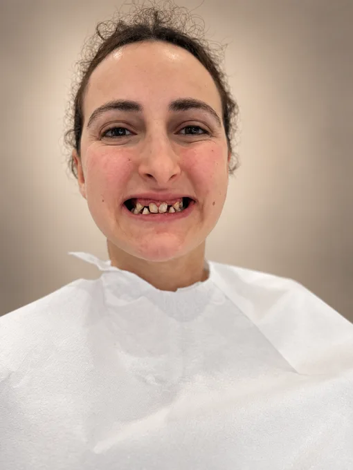 Zirkoniumkronor — 06.05.2026 – 17.06.2026 — Patientfoto