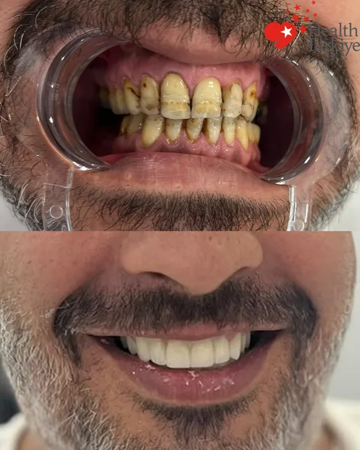 Komplett leendeförvandling — implantat & zirkoniumkronor — 19.05.2025 – 14.01.2026 — Före- och efterjämförelse