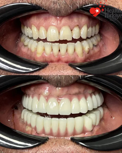 Réhabilitation complète du sourire: implants et couronnes en zircone — 15.05.2026 – 24.09.2026 — Comparaison avant-après