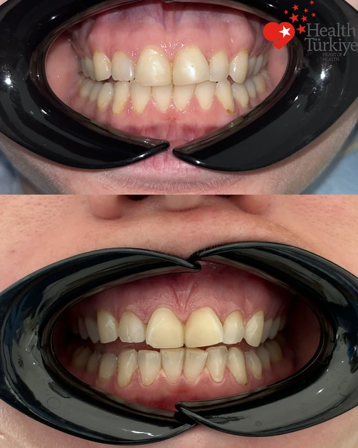 Blanchiment avancé des dents — 29.09.2026 – 29.09.2026 — Comparaison avant-après